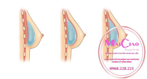 Khám Phá Các Phương Pháp Nâng Ngực Không Để Lại Sẹo Tại Việt Nam